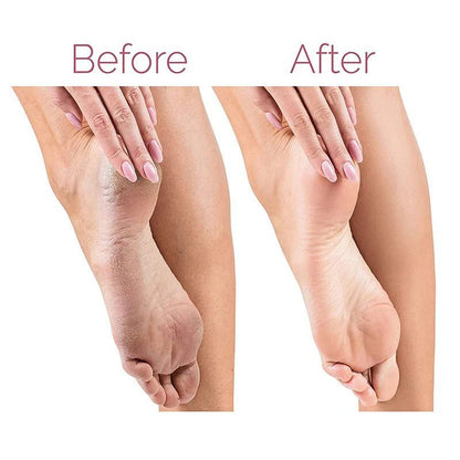 SoleSmooth™ Electric Foot File & Callus Remover